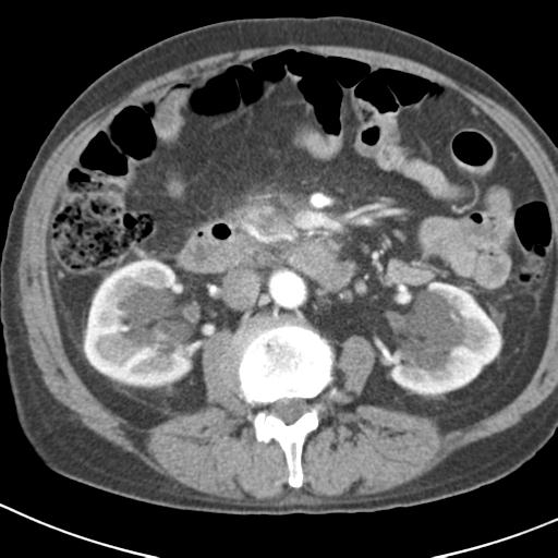 File:Acute pancreatitis and walled-off necrosis (Radiopaedia 29888-30403 Axial C+ portal venous phase 25).jpg