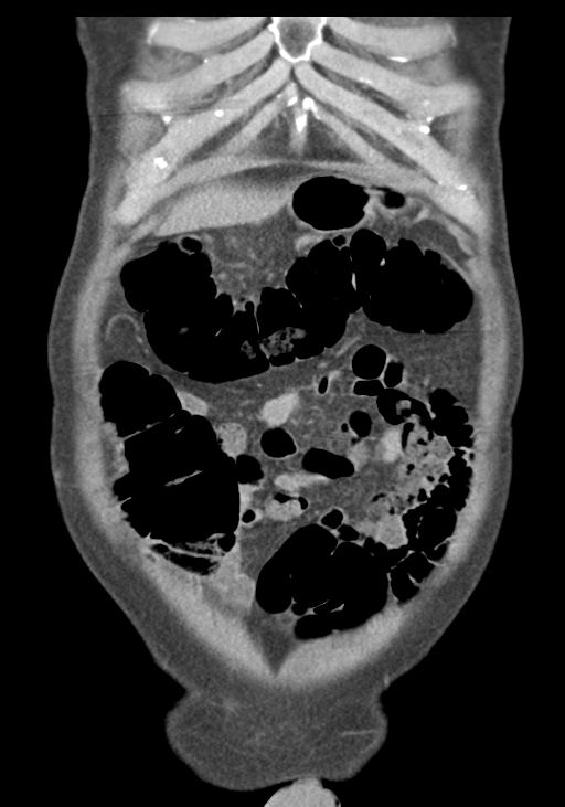 Acute pancreatitis and walled-off necrosis (Radiopaedia 29888-30403 E 12).jpg