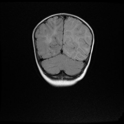 File:Acute phase of hemiconvulsion-hemiplegia epilepsy syndrome (Radiopaedia 29309-29745 Coronal FLAIR 18).jpg