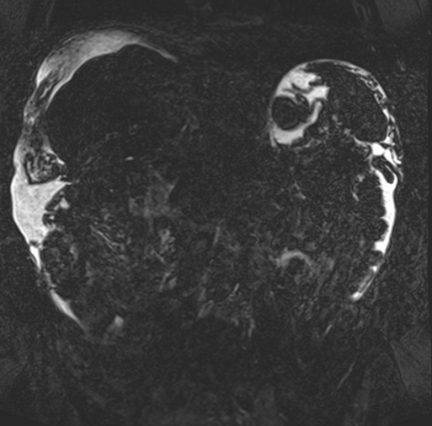 Acute portal vein thrombosis (Radiopaedia 73198-83925 Coronal Heavily T2 thin cuts 51).jpg