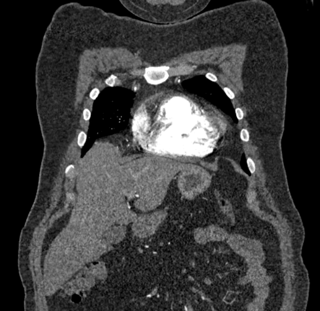 Acute pulmonary embolism with pulmonary infarcts (Radiopaedia 77688-89908 Coronal C+ CTPA 5).jpg