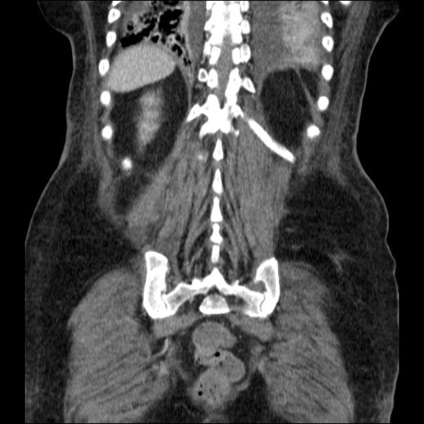 Acute pyelonephritis (Radiopaedia 26584-26729 C+ portal venous phase 60).jpg
