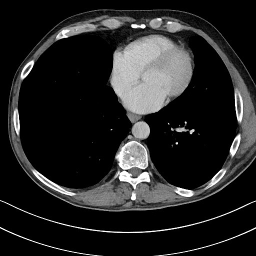 Acute renal infarction - rim capsular enhancement (Radiopaedia 59833-67270 Axial C+ portal venous phase 3).jpg