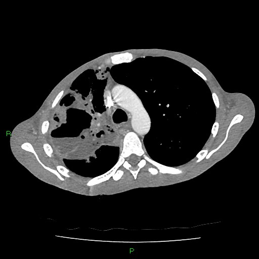 File:Acute right lung abscess (Radiopaedia 34806-36258 Axial C+ arterial phase 60).jpg