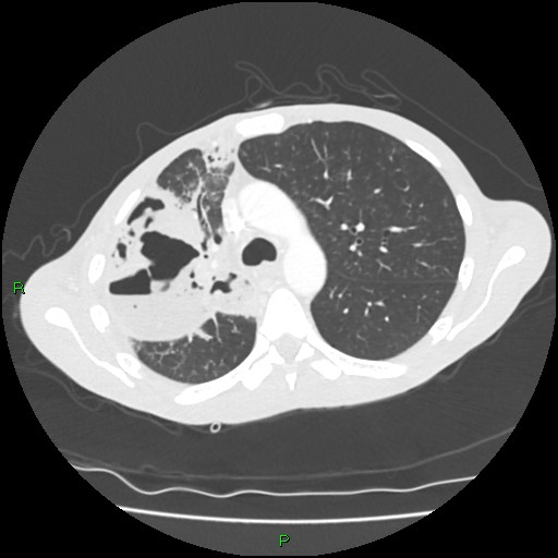 Acute right lung abscess (Radiopaedia 34806-36258 Axial lung window 62).jpg
