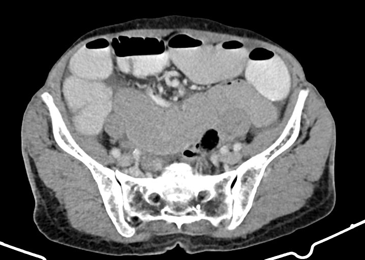 Acute small bowel (ileal) volvulus (Radiopaedia 71740-82139 Axial C+ portal venous phase 151).jpg