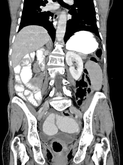 Acute small bowel (ileal) volvulus (Radiopaedia 71740-82139 Coronal C+ portal venous phase 71).jpg