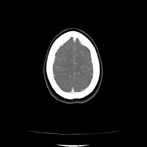 Acute subarachnoid hemorrhage and accessory anterior cerebral artery (Radiopaedia 69231-79009 Axial C+ arterial phase 118).jpg
