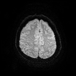 File:Acute superior cerebellar artery territory infarct (Radiopaedia 84104-99358 Axial DWI 9).jpg