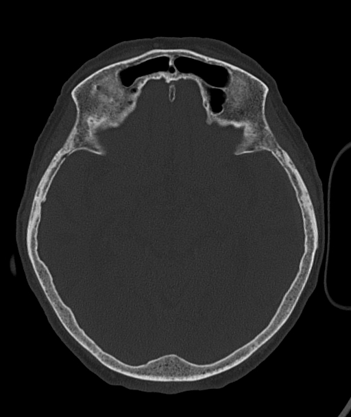 Acute traumatic subdural hematoma (Radiopaedia 82921-97257 Axial bone window 64).jpg