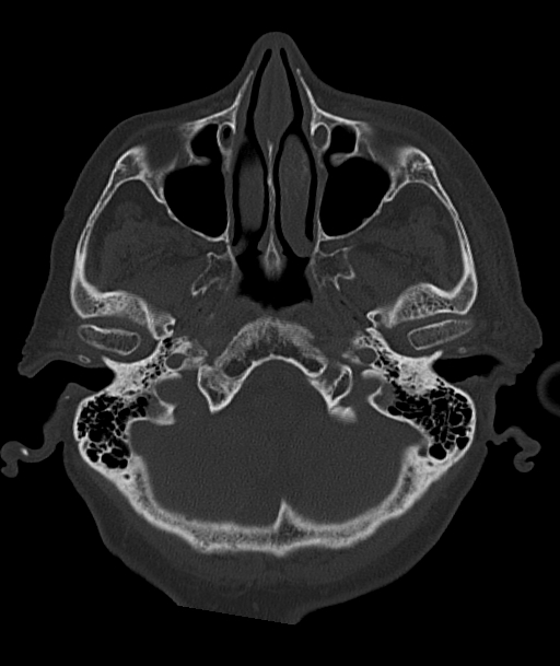 Acute traumatic subdural hematoma (Radiopaedia 82921-97257 Axial bone window 89).jpg