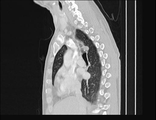 File:Addison disease (Radiopaedia 49318-54412 Sagittal lung window 37).jpg