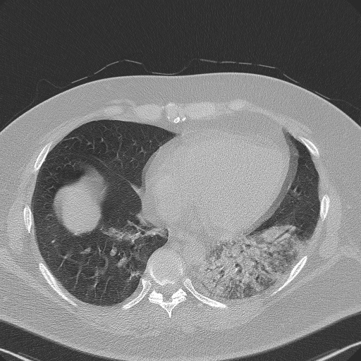 Adenoid cystic carcinoma of the trachea (Radiopaedia 49042-54137 Axial lung window 244).jpg