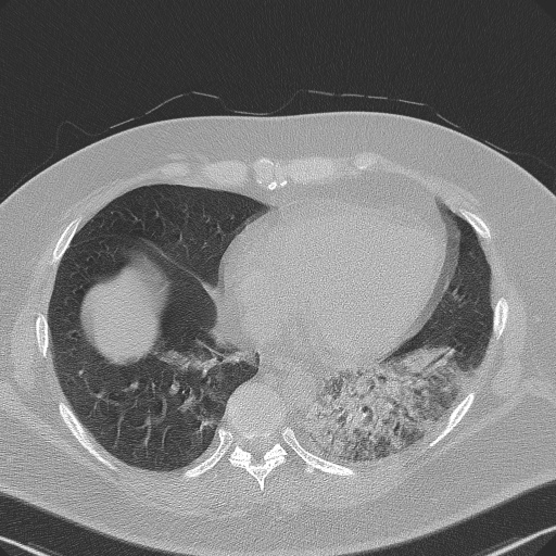 Adenoid cystic carcinoma of the trachea (Radiopaedia 49042-54137 Axial lung window 245).jpg