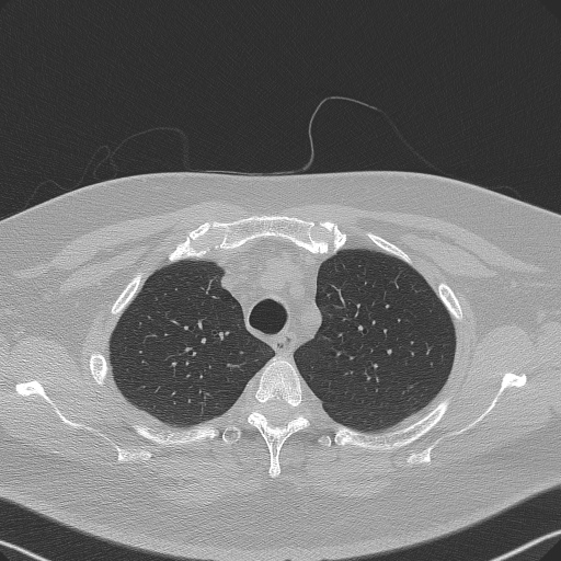 Adenoid cystic carcinoma of the trachea (Radiopaedia 49042-54137 Axial lung window 73).jpg