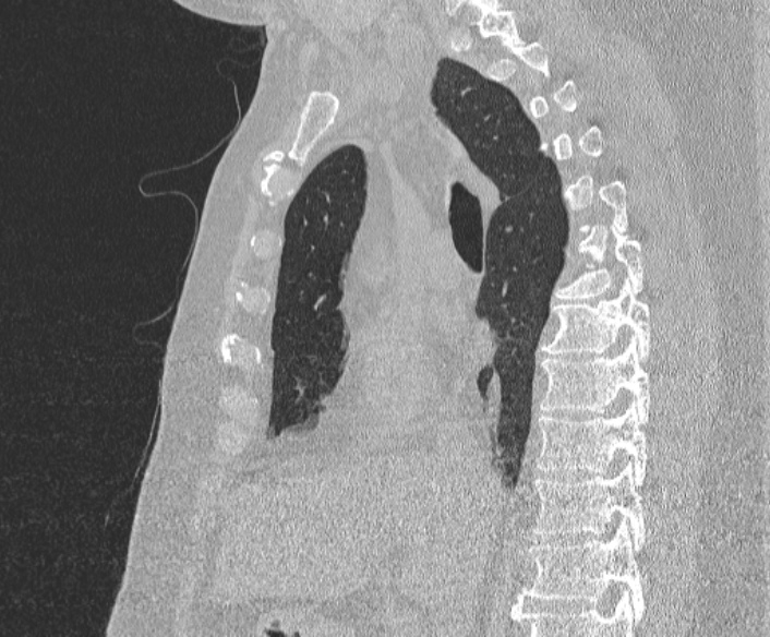 Adenoid cystic carcinoma of the trachea (Radiopaedia 49042-54137 Sagittal lung window 212).jpg