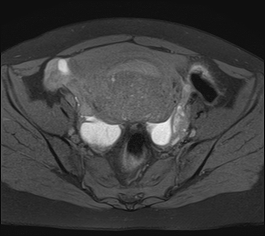 File:Adenomyosis - ovarian endometriomas (Radiopaedia 67031-76350 Axial T1 fat sat 12).jpg