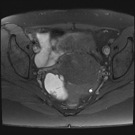 File:Adenomyosis and endometriotic cysts (Radiopaedia 82300-96367 Axial T1 fat sat 12).jpg