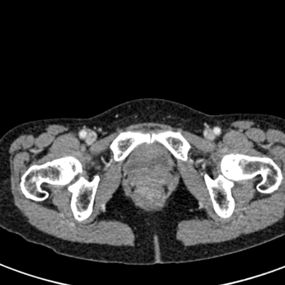 File:Adhesional small bowel obstruction (Radiopaedia 48397-53305 Axial C+ portal venous phase 94).jpg