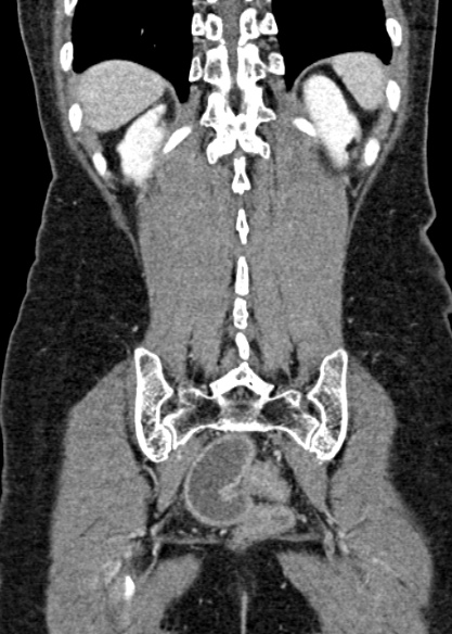 Adhesional small bowel obstruction (Radiopaedia 48397-53305 Coronal C+ portal venous phase 288).jpg