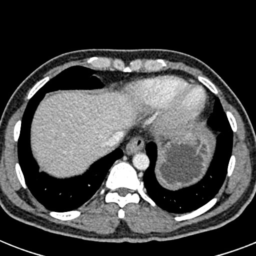Adhesional small bowel obstruction (Radiopaedia 58900-66131 Axial C+ portal venous phase 5).jpg