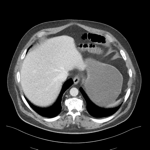 Adhesions within abdominal wall hernia (Radiopaedia 58283-65394 Axial C+ portal venous phase 14).png