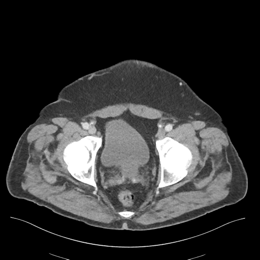 Adhesions within abdominal wall hernia (Radiopaedia 58283-65394 Axial C+ portal venous phase 78).png