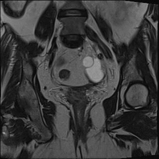 File:Adnexal multilocular cyst (O-RADS US 3- O-RADS MRI 3) (Radiopaedia 87426-103754 Coronal T2 19).jpg