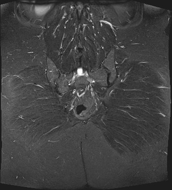 File:Adnexal multilocular cyst (O-RADS US 3- O-RADS MRI 3) (Radiopaedia 87426-103754 Coronal T2 fat sat 30).jpg