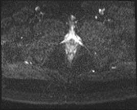 File:Adnexal multilocular cyst (O-RADS US 3. O-RADS MRI 3) (Radiopaedia 87426-103754 Axial 125).jpeg