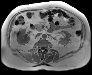 File:Adrenal cortical carcinoma (Radiopaedia 64017-72770 Axial T1 in-phase 42).jpg