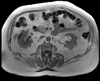 File:Adrenal cortical carcinoma (Radiopaedia 64017-72770 Axial T1 in-phase 43).jpg