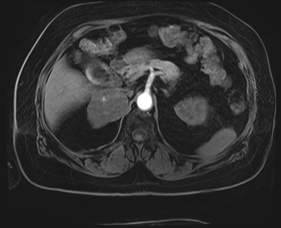 Adrenal cortical carcinoma (Radiopaedia 64017-72770 H 11).jpg