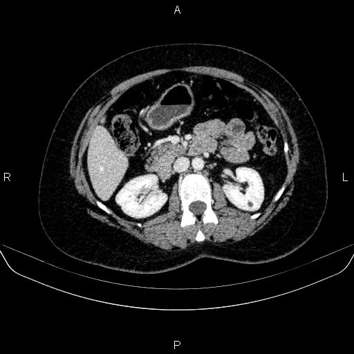 Adrenal cortical carcinoma (Radiopaedia 84882-100379 Axial C+ portal venous phase 37).jpg