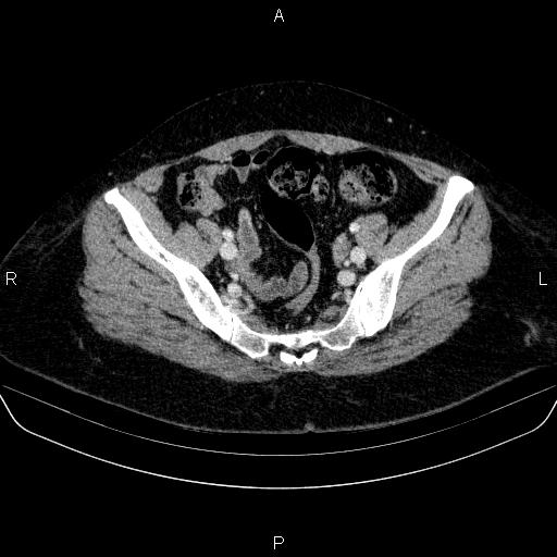 Adrenal cortical carcinoma (Radiopaedia 84882-100379 Axial C+ portal venous phase 78).jpg
