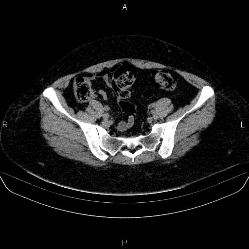 File:Adrenal cortical carcinoma (Radiopaedia 84882-100379 Axial non-contrast 74).jpg