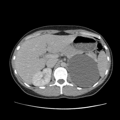 Adrenal cyst (Radiopaedia 64869-73813 Axial C+ portal venous phase 23).jpg