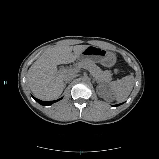 Adrenal cystic lymphangioma (Radiopaedia 83161-97534 Axial non-contrast 30).jpg