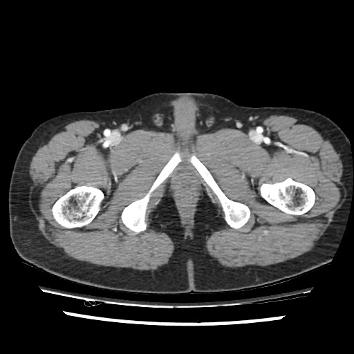 File:Adrenal gland trauma (Radiopaedia 81351-95078 Axial Dual bolus trauma C+ 126).jpg