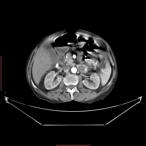 Adrenal hemangioma (Radiopaedia 68923-78668 Axial C+ arterial phase 33).jpg