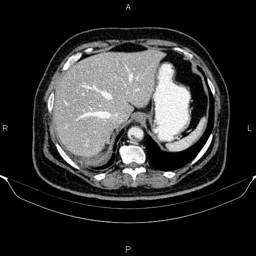 Adrenal hemorrhage (Radiopaedia 62622-70916 Axial C+ portal venous phase 26).jpg