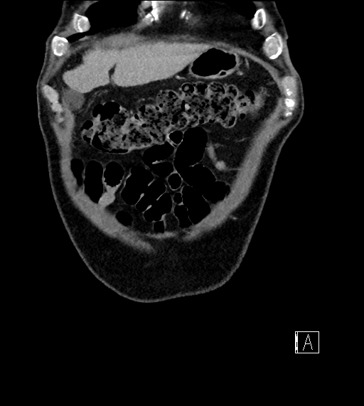Adrenal lymphoma (Radiopaedia 73730-84529 Coronal C+ portal venous phase 10).jpg