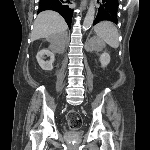 Adrenal lymphoma (Radiopaedia 84145-99415 Coronal C+ portal venous phase 60).jpg