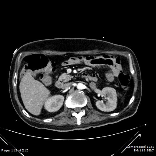 Adrenal metastasis (Radiopaedia 78425-91079 Axial C+ arterial phase 43).jpg