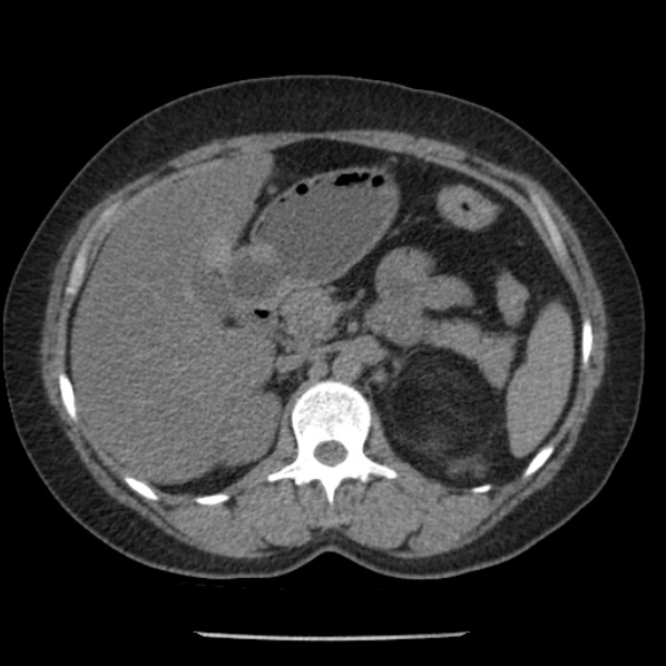 Adrenal myelolipoma (Radiopaedia 43401-46759 Axial non-contrast 29).jpg