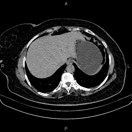 Adrenal myelolipoma (Radiopaedia 82742-96986 Axial non-contrast 15).jpg
