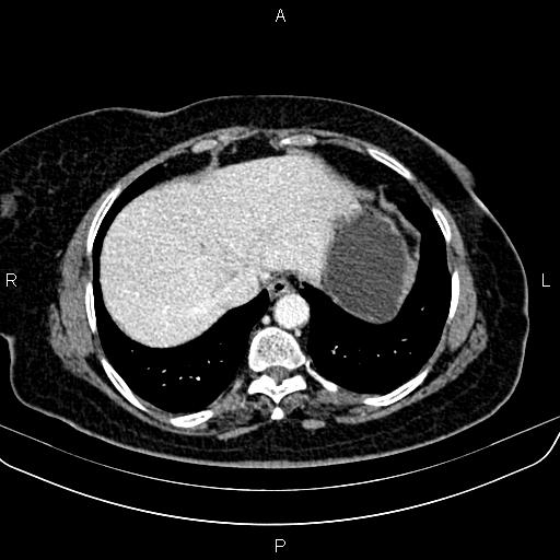 Adrenal myelolipoma (Radiopaedia 82742-96986 Axial renal cortical phase 19).jpg