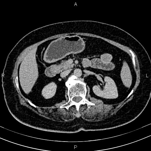 Adrenal myelolipoma (Radiopaedia 82742-96986 Axial renal excretory phase 55).jpg