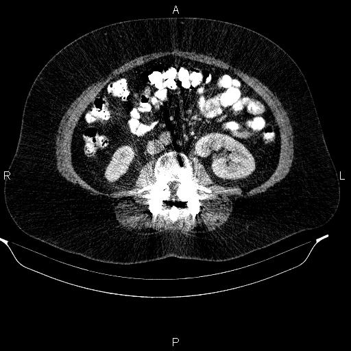 Adrenal myelolipoma (Radiopaedia 84319-99617 Axial renal cortical phase 60).jpg