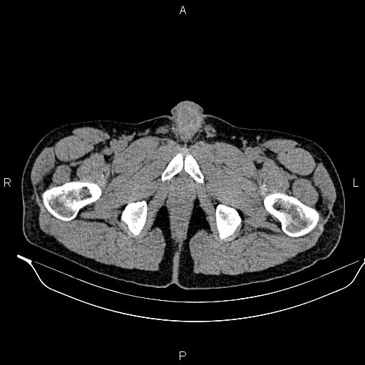Adrenal myelolipoma (Radiopaedia 87794-104246 Axial non-contrast 112).jpg